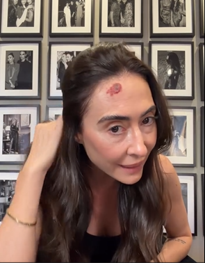 Rocío Martín Berrocal muestra la lesión de la frente en su vídeo